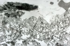 M, 1y. | epidermolysis bullosa … junctional type M, 1y. | epidermolysis bullosa … junctional type